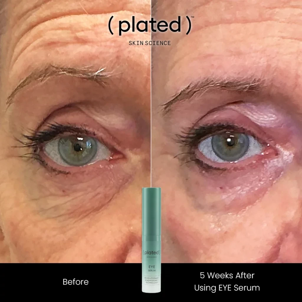 Before-afrer-A-PRP Treatments In Las Vegas, NV