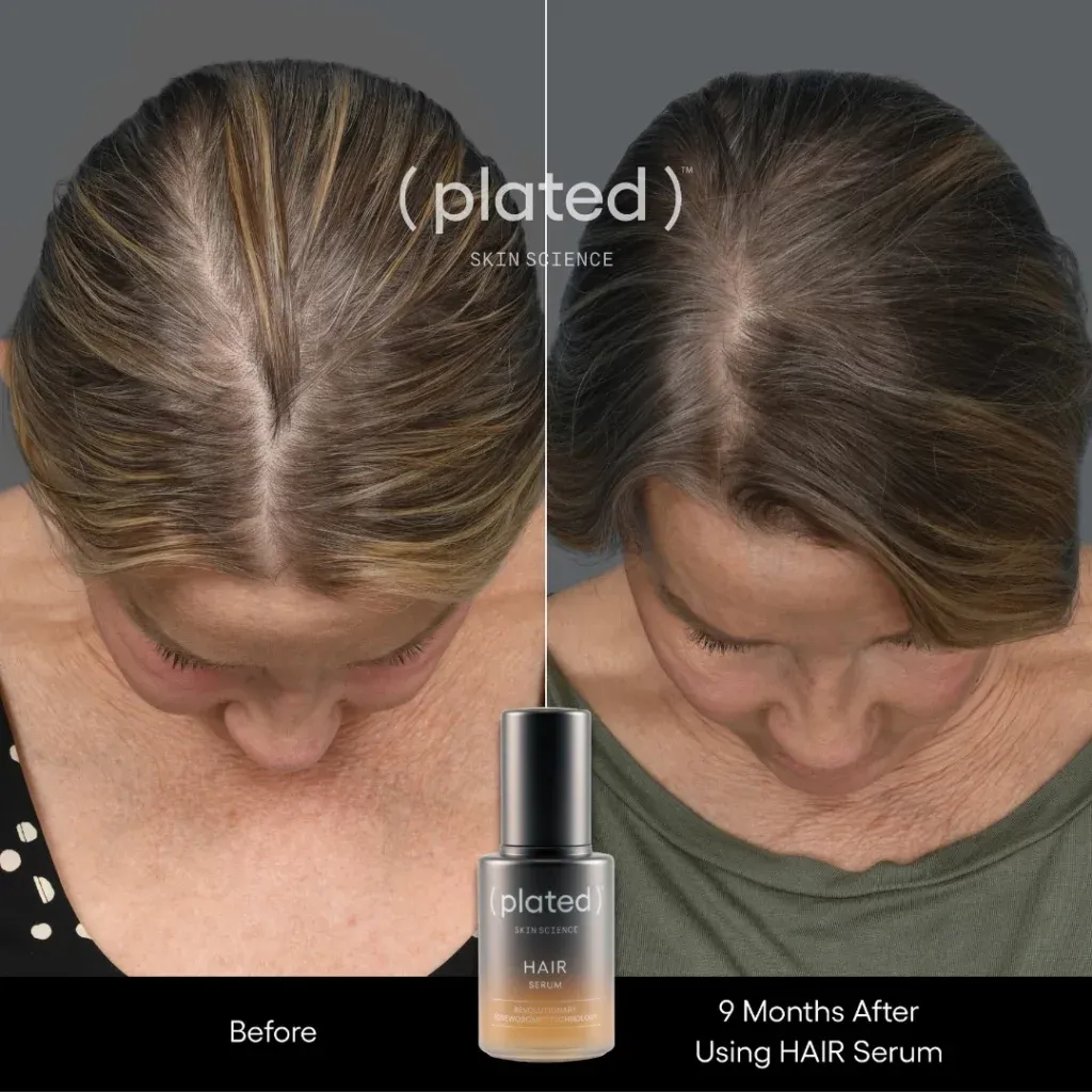 Before-afrer- B-PRP Treatments In Las Vegas, NV