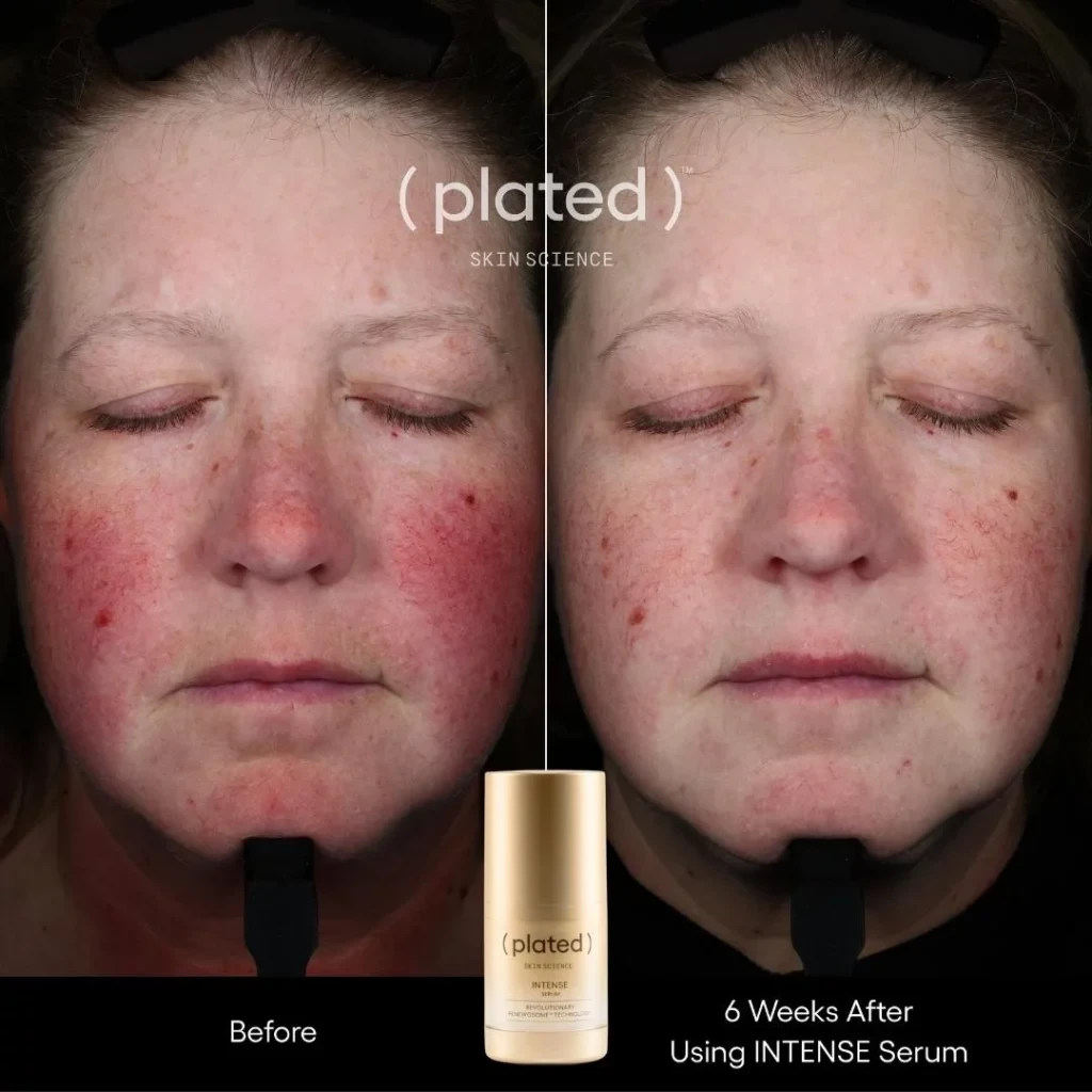 Before-afrer-C-PRP Treatments In Las Vegas, NV