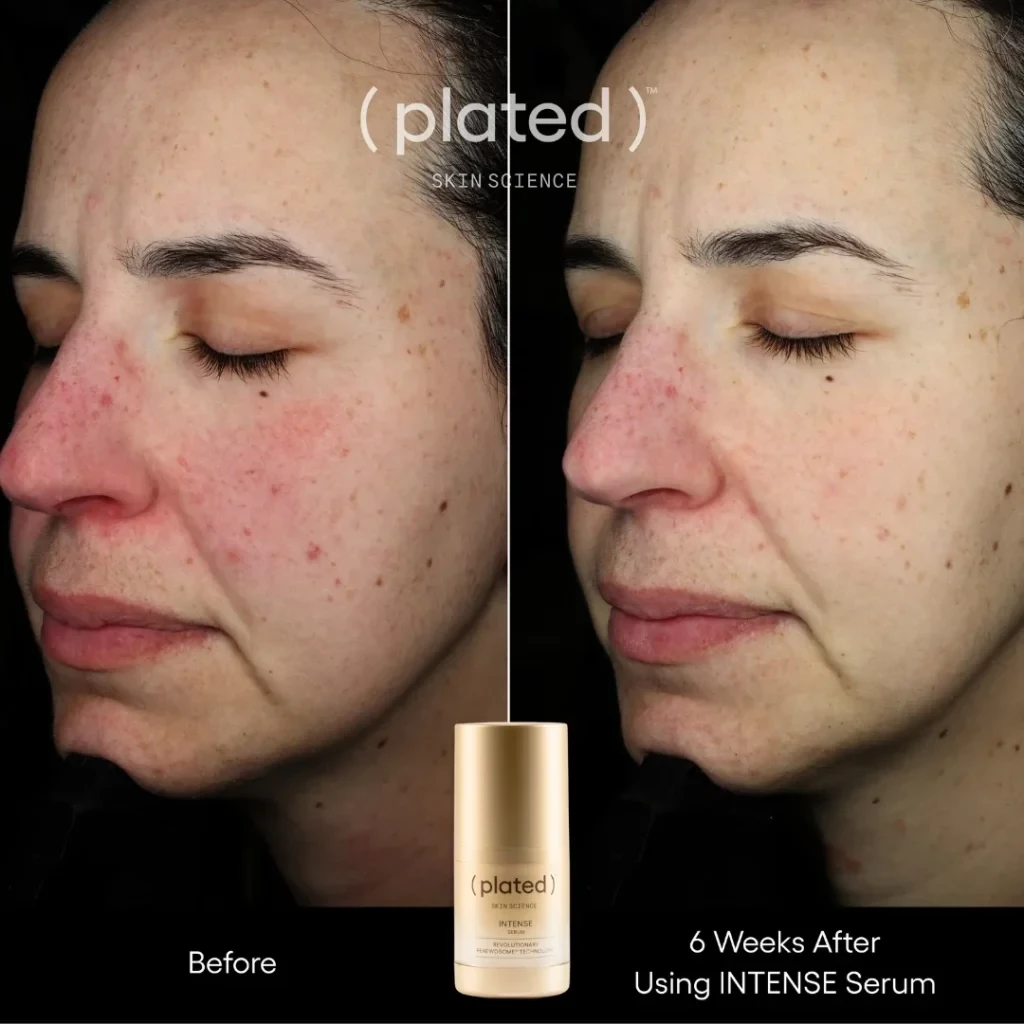 Before-afrer-D-PRP Treatments In Las Vegas, NV