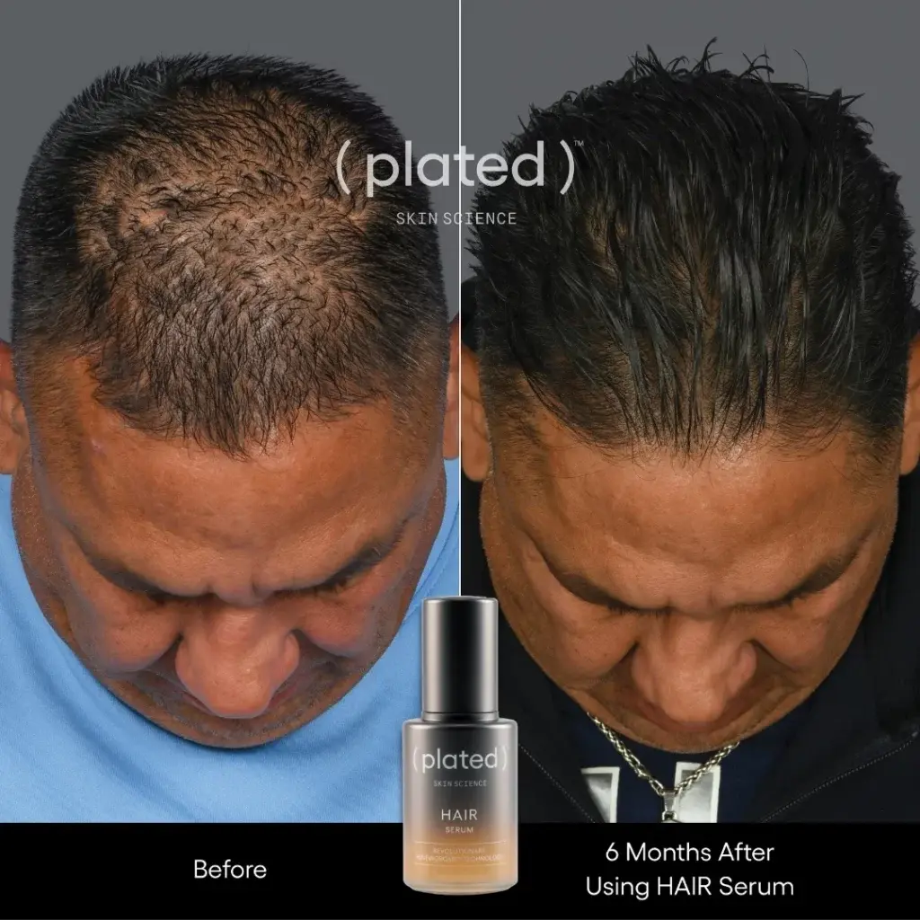 Before-afrer-E-PRP Treatments In Las Vegas, NV