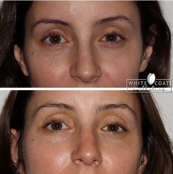 Before-afrer-PRP Treatments In Las Vegas, NV