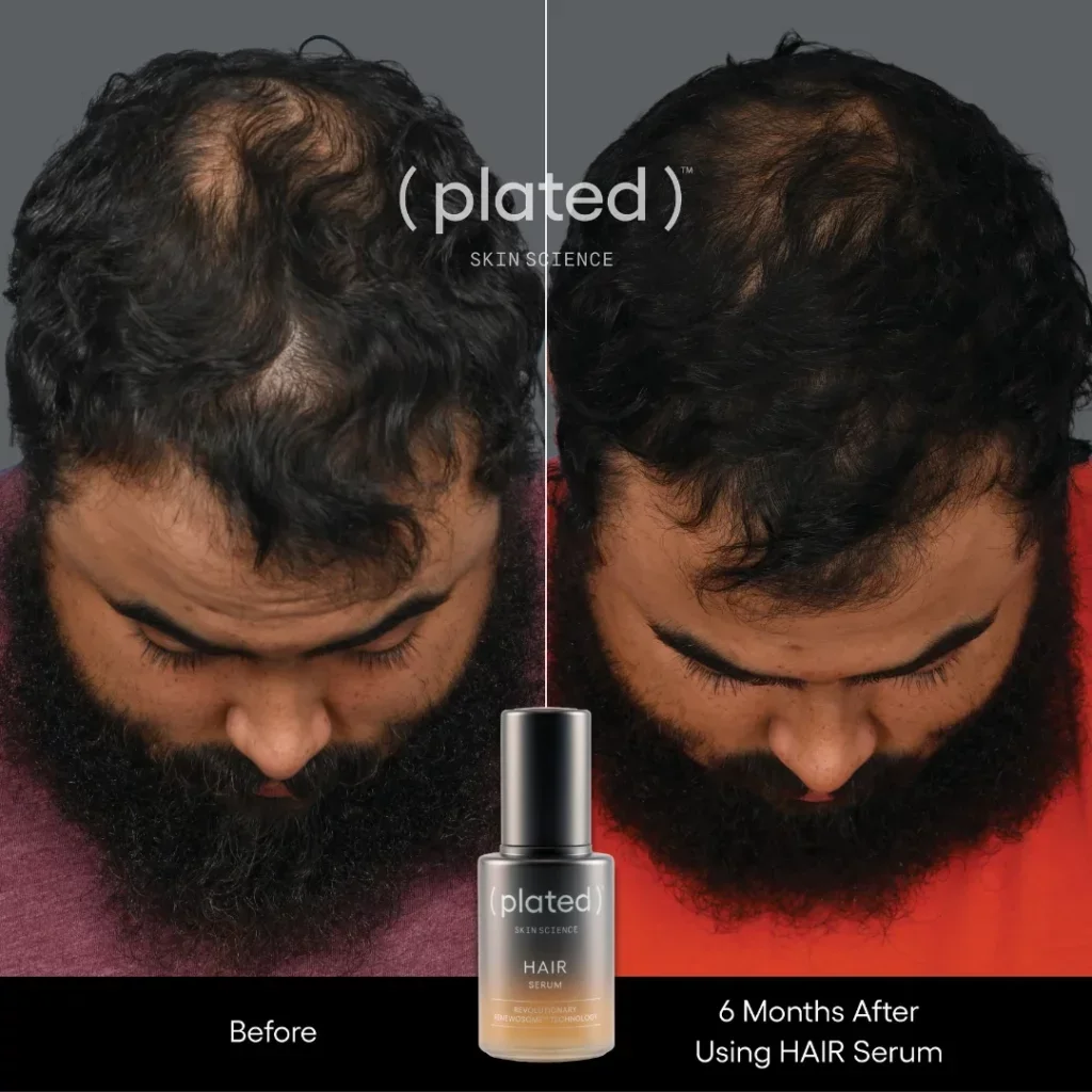 Before-afrerimagePRP Treatments In Las Vegas, NV