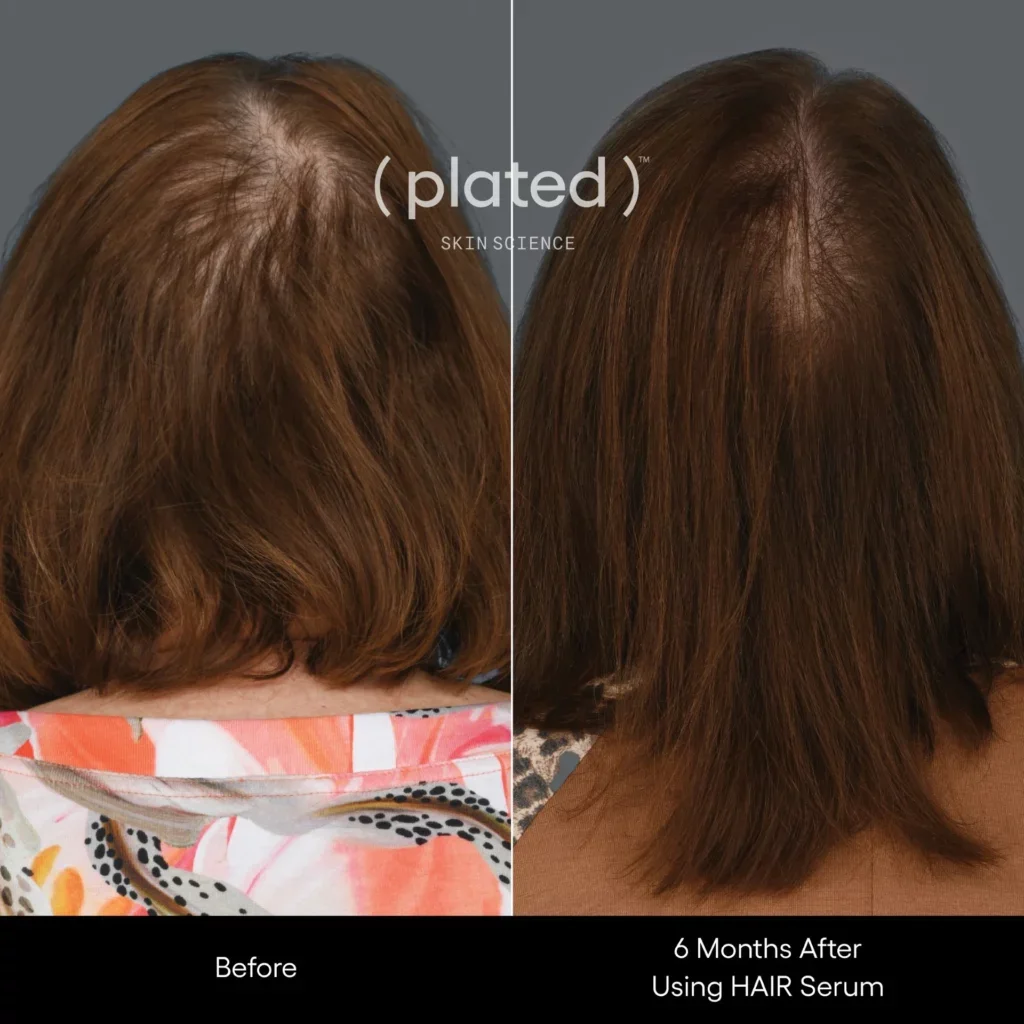 Before-afrerimage_APRP Treatments In Las Vegas, NV