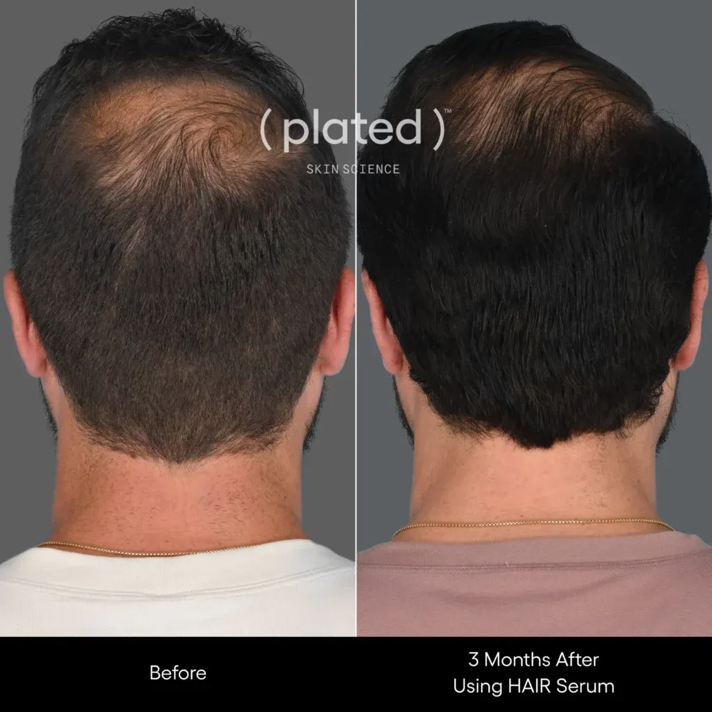 Before-afrerimage_BPRP Treatments In Las Vegas, NV