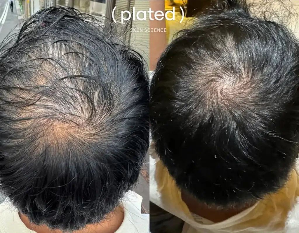 Before-afrerimage_CPRP Treatments In Las Vegas, NV