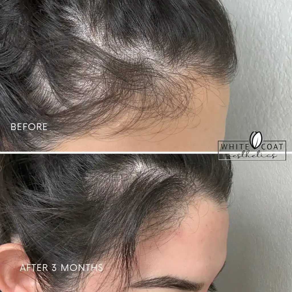Before-afrerimage_G-PRP Treatments In Las Vegas, NV