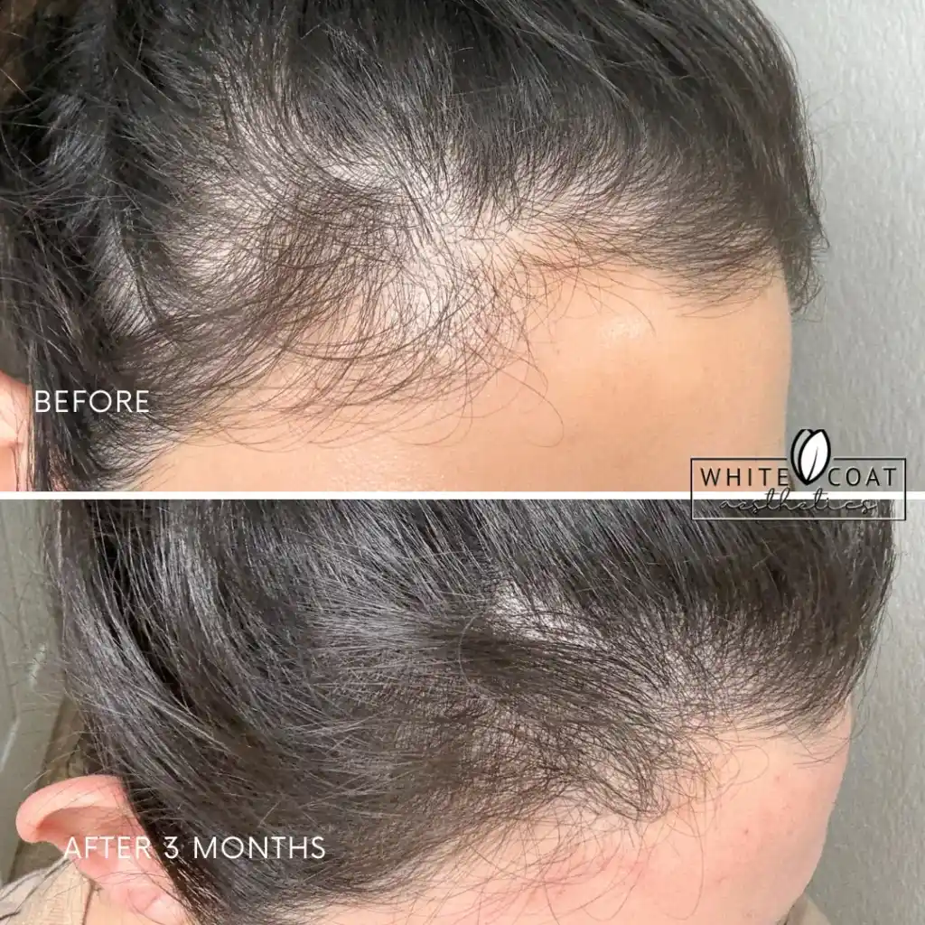 Before-afrerimage_H-PRP Treatments In Las Vegas, NV