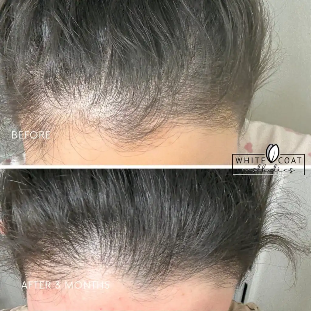 Before-afrerimage_I-PRP Treatments In Las Vegas, NV
