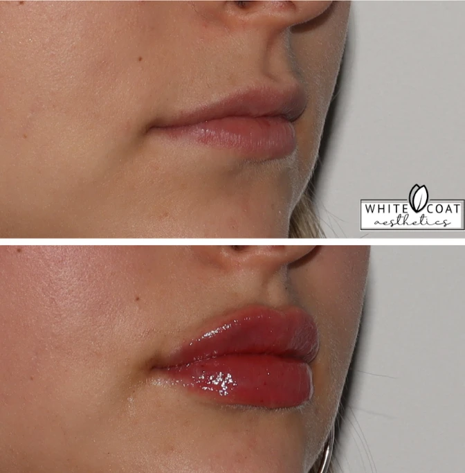 Gallery White Coat Aesthetics ADermal Fillers In Las Vegas, NV