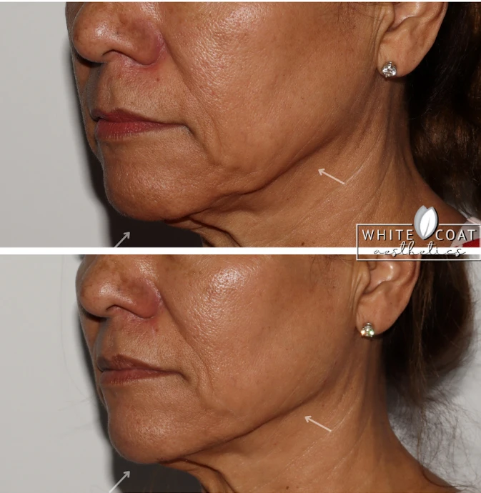 Gallery White Coat Aesthetics BDermal Fillers In Las Vegas, NV