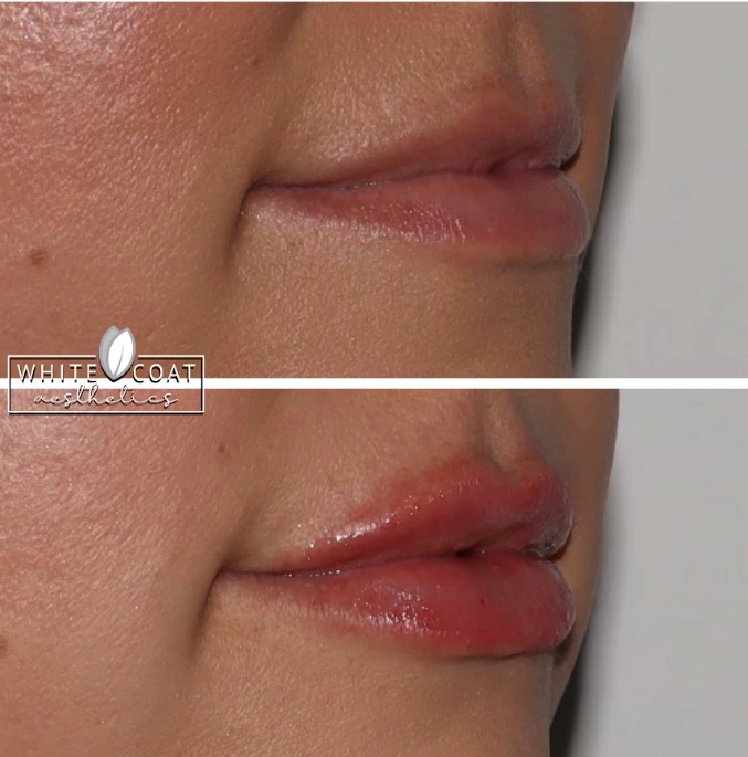 Gallery White Coat Aesthetics CDermal Fillers In Las Vegas, NV