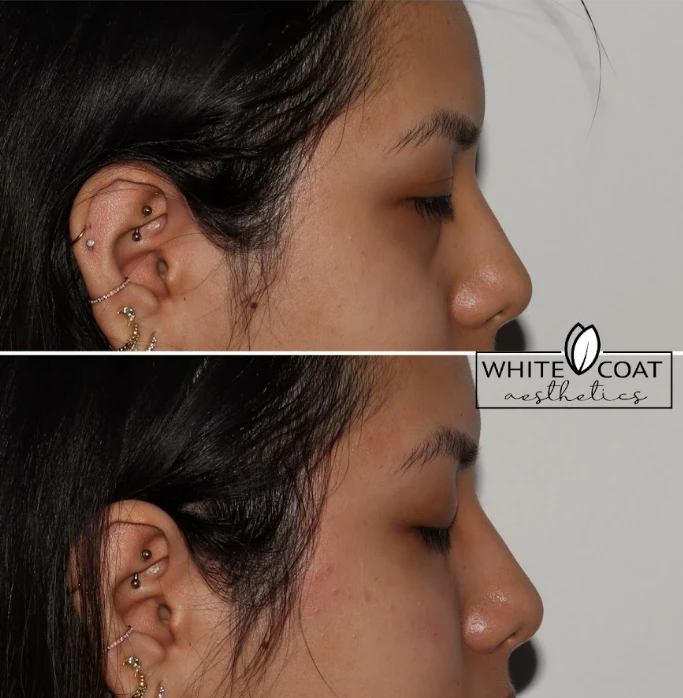 Gallery White Coat Aesthetics DDermal Fillers In Las Vegas, NV