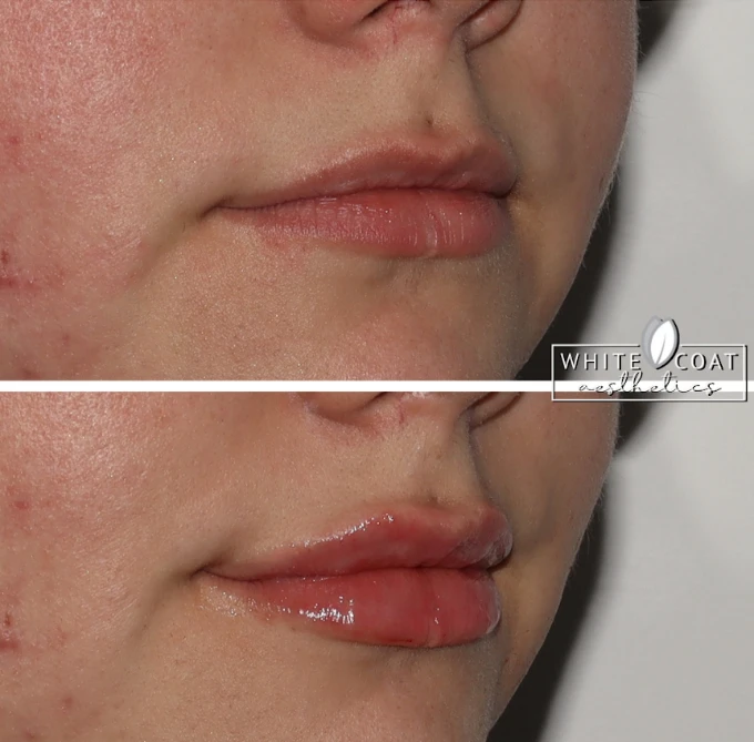 Gallery White Coat Aesthetics EDermal Fillers In Las Vegas, NV