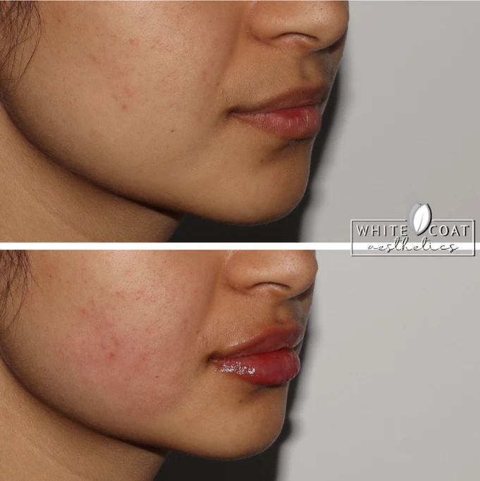 Gallery White Coat AestheticsDermal Fillers In Las Vegas, NV