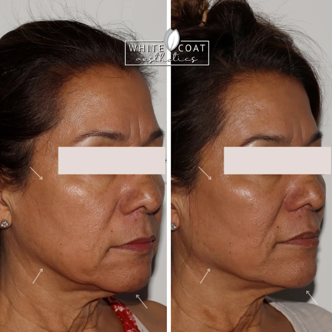 White Coat Aesthetics GalleryDermal Fillers In Las Vegas, NV